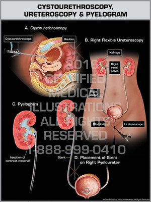 Exhibit of Cystourethroscopy, Ureteroscopy & Pyelogram - Print Quality Instant Download Exhibit of Cystourethroscopy, Ureteroscopy & Pyelogram - Print Quality Instant Download