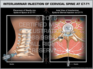 Exhibit of Interlaminar Injection of Cervical Spine at C7-T1 Exhibit of Interlaminar Injection of Cervical Spine at C7-T1