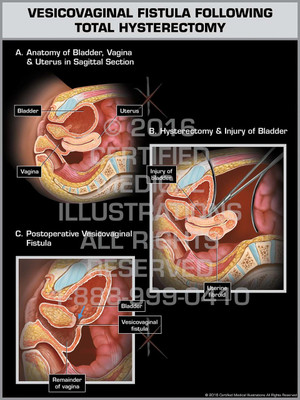 Exhibit of Vesicovaginal Fistula Following Total Hysterectomy - Print Quality Instant Download Exhibit of Vesicovaginal Fistula Following Total Hysterectomy - Print Quality Instant Download