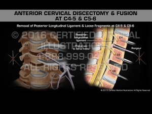Animation of Anterior Cervical Discectomy & Fusion at C4-5 & C5-6 Animation of Anterior Cervical Discectomy & Fusion at C4-5 & C5-6