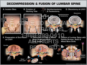 Exhibit of Decompression & Fusion of Lumbar Spine - Print Quality Instant Download Exhibit of Decompression & Fusion of Lumbar Spine - Print Quality Instant Download