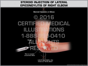 Exhibit of Steroid Injection of Lateral Epicondylitis of Right Elbow - Print Quality Instant Download Exhibit of Steroid Injection of Lateral Epicondylitis of Right Elbow - Print Quality Instant Download