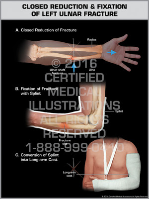 Exhibit of Closed Reduction & Fixation of Left Ulnar Fracture - Print Quality Instant Download