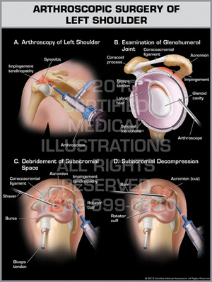Exhibit of Arthroscopic Surgery of Left Shoulder.