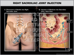 Exhibit of Right Sacroiliac Joint Injection - Print Quality Instant Download Exhibit of Right Sacroiliac Joint Injection - Print Quality Instant Download