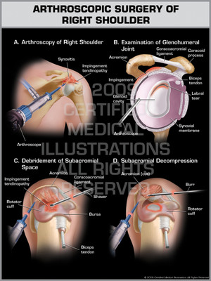 Exhibit of Arthroscopic Surgery of Right Shoulder.