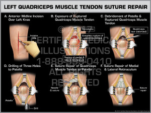 Exhibit of Left Quadriceps Muscle Tendon Suture Repair - Print Quality Instant Download Exhibit of Left Quadriceps Muscle Tendon Suture Repair - Print Quality Instant Download