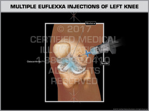 Exhibit of Multiple Euflexxa Injections of Left Knee Exhibit of Multiple Euflexxa Injections of Left Knee