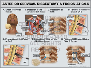 Exhibit of Anterior Cervical Discectomy & Fusion at C4-5 - Print Quality Instant Download