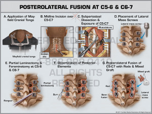 Posterolateral Fusion at C5-6 & C6-7- Print Quality Instant Download