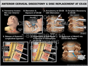 Anterior Cervical Discectomy & Disc Replacement at C5-6- Print Quality Instant Download
