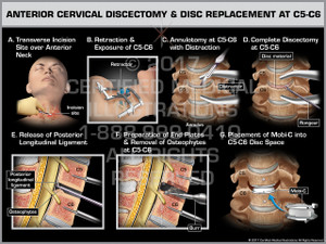 Anterior Cervical Discectomy & Disc Replacement at C5-6- Print Quality Instant Download Anterior Cervical Discectomy & Disc Replacement at C5-6- Print Quality Instant Download