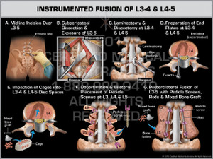 Instrumented fusion of L3-4 & L4-5