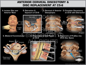Exhibit of Anterior Cervical Discectomy & Replacement at C5-6 - Print Quality Instant Download