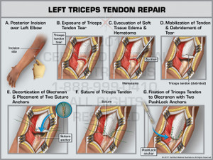 Exhibit of Left Triceps Tendon Repair - Print Quality Instant Download Exhibit of Left Triceps Tendon Repair - Print Quality Instant Download