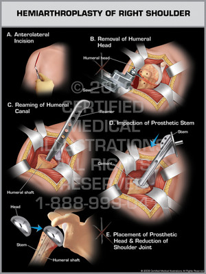 Exhibit of Hemiarthroplasty of Right Shoulder. Exhibit of Hemiarthroplasty of Right Shoulder.