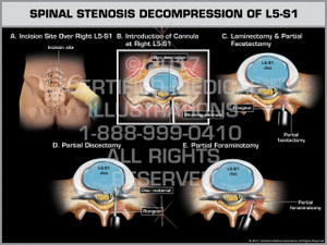 Exhibit of Spinal Stenosis Decompression of L5-S1 - Print Quality Instant Download Exhibit of Spinal Stenosis Decompression of L5-S1 - Print Quality Instant Download