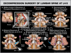 Exhibit of Decompression Surgery of Lumbar Spine at L4-5 - Print Quality Instant Download Exhibit of Decompression Surgery of Lumbar Spine at L4-5 - Print Quality Instant Download