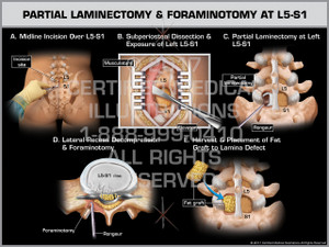 Exhibit of Partial Laminectomy & Foraminotomy at L5-S1 - Print Quality Instant Download