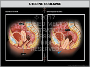 Exhibit of Uterine Prolapse Exhibit of Uterine Prolapse