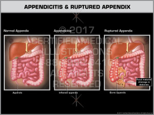 Appendicitis & Ruptured Appendix- Print Quality Instant Download Appendicitis & Ruptured Appendix- Print Quality Instant Download