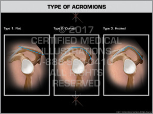 Exhibit of Type of Acromions