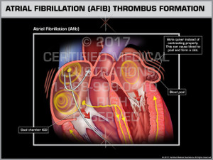 Exhibit of Atrial Fibrillation (AFIB) Thrombus Formation