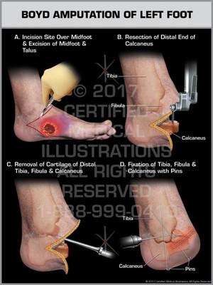 Exhibit of Boyd Amputation of Left Foot
