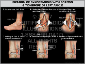 Exhibit of Fixation of Syndesmosis with Screws & Tightrope of Left Ankle Exhibit of Fixation of Syndesmosis with Screws & Tightrope of Left Ankle