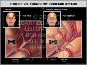 Stroke Vs. Transient Ischemic Attack Stroke Vs. Transient Ischemic Attack