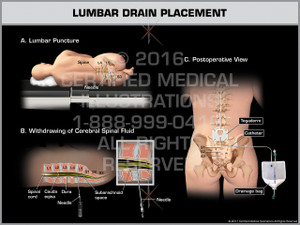 Lumbar Drain Placement - Print Quality Instant Download Lumbar Drain Placement - Print Quality Instant Download
