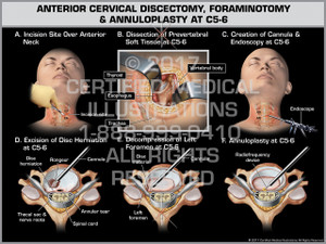 Anterior Cervical Discectomy, Foraminotomy, & Annuloplasty at C5-6 Anterior Cervical Discectomy, Foraminotomy, & Annuloplasty at C5-6
