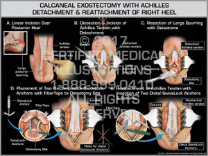 Calcaneal Exostectomy with Achilles Detachment & Reattachment of Right Heel Calcaneal Exostectomy with Achilles Detachment & Reattachment of Right Heel