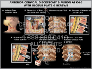 Exhibit of Anterior Cervical Discectomy & Fusion at C4-5 with Globus Plate & Screws Exhibit of Anterior Cervical Discectomy & Fusion at C4-5 with Globus Plate & Screws