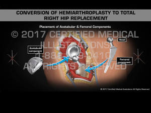 Animation of Conversion of Hemiarthroplasty to Total Right Hip Replacement Animation of Conversion of Hemiarthroplasty to Total Right Hip Replacement