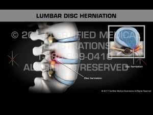 Animation of Lumbar Disc Herniation Animation of Lumbar Disc Herniation