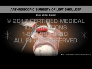 Animation of Arthroscopic Surgery of Left Shoulder Animation of Arthroscopic Surgery of Left Shoulder