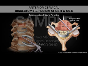 Anterior Cervical Discectomy & Fusion at C3-4 & C5-6 Anterior Cervical Discectomy & Fusion at C3-4 & C5-6