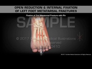 Open Reduction & Internal Fixation of Left Foot Metatarsal Fractures Open Reduction & Internal Fixation of Left Foot Metatarsal Fractures