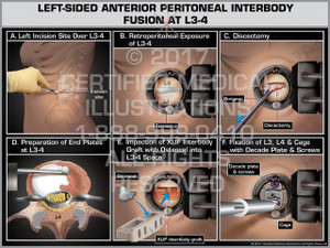 Left Sided Anterior Peritoneal Interbody Fusion at L3-4 Left Sided Anterior Peritoneal Interbody Fusion at L3-4