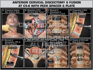 Anterior Cervical Discectomy & Fusion at C5-6 with PEEK Spacer and Plate Anterior Cervical Discectomy & Fusion at C5-6 with PEEK Spacer and Plate