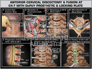Anterior Cervical Discectomy & Fusion at C4-7 with DePuy Prosthetic & Locking Plate Anterior Cervical Discectomy & Fusion at C4-7 with DePuy Prosthetic & Locking Plate