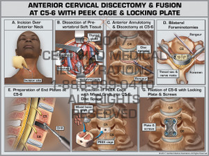 Anterior Cervical Discectomy & Fusion at C5-6 with PEEK Cage and Locking Plate Anterior Cervical Discectomy & Fusion at C5-6 with PEEK Cage and Locking Plate