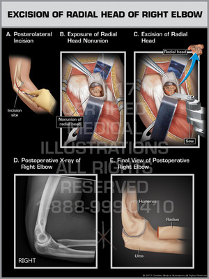 Exhibit of Excision of Radial Head of Right Elbow