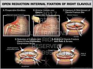 Exhibit of Open Reduction Internal Fixation of Right Clavicle Exhibit of Open Reduction Internal Fixation of Right Clavicle