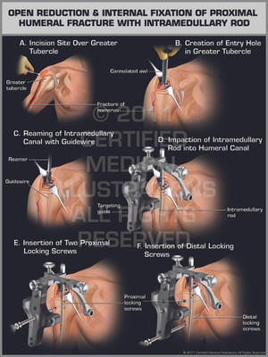 Exhibit of ORIF of Proximal Humeral Fracture with Intramedullary Rod. Exhibit of ORIF of Proximal Humeral Fracture with Intramedullary Rod.