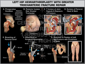 Exhibit of Left Hip Hemiarthroplasty with Greater Trochanteric Fracture Repair- Print Quality Instant Download Exhibit of Left Hip Hemiarthroplasty with Greater Trochanteric Fracture Repair- Print Quality Instant Download
