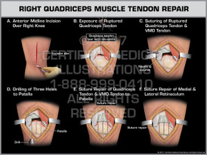 Exhibit of Right Quadriceps Muscle Tendon Repair- Print Quality Instant Download