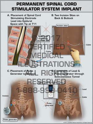 Exhibit of Permanent Spinal Cord Stimulator System Implant