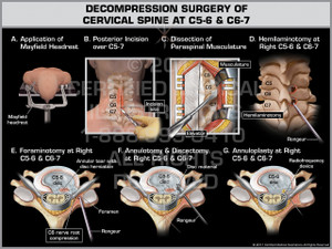 Exhibit of Decompression Surgery of Cervical Spine at C5-6 & C6-7 Exhibit of Decompression Surgery of Cervical Spine at C5-6 & C6-7